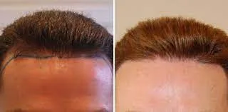 Expert Hair Transplant Solutions