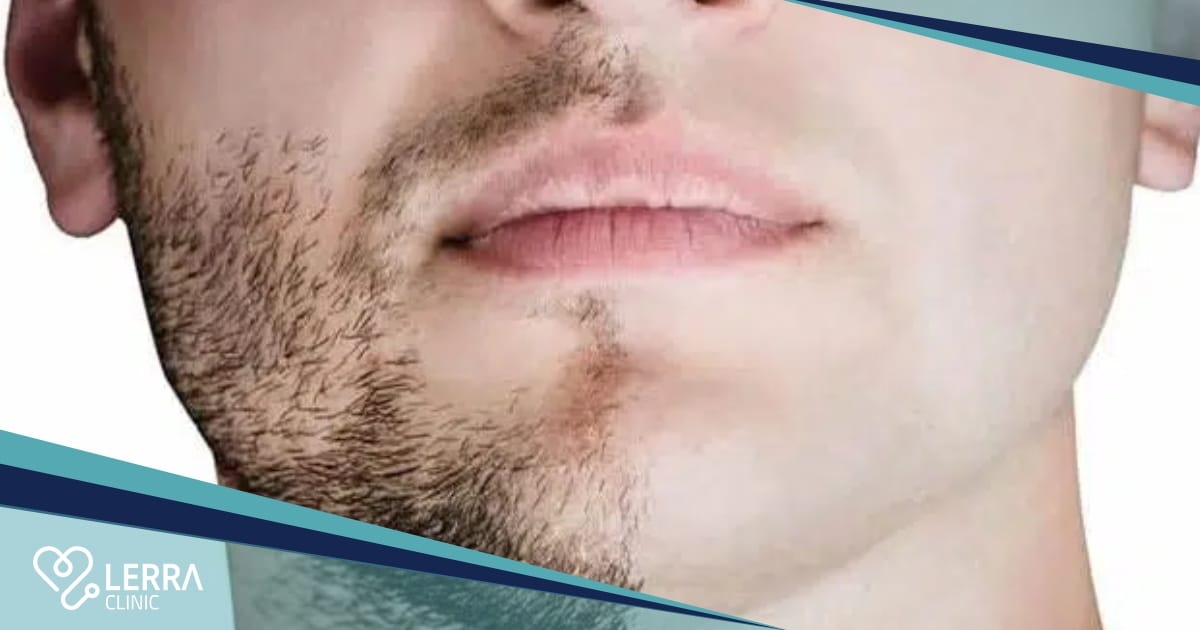 Full Well-Defined Beard with our specialized transplants