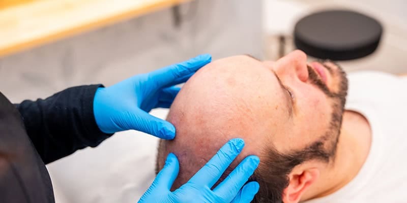فهم تكاليف زراعة الشعر