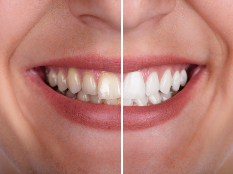 Smile Makeover vs. Single Dental Treatments