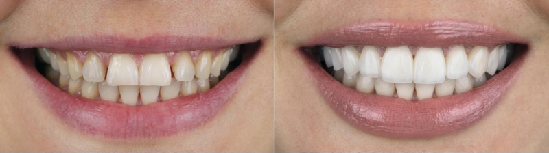 Smile Makeover vs. Single Dental Treatments