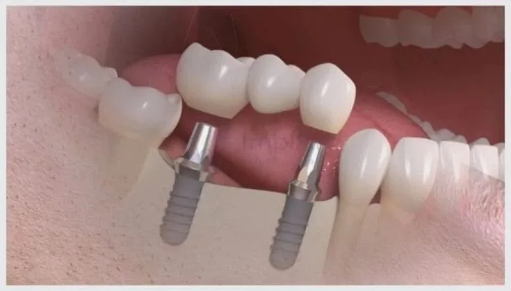  Straumann dental implants