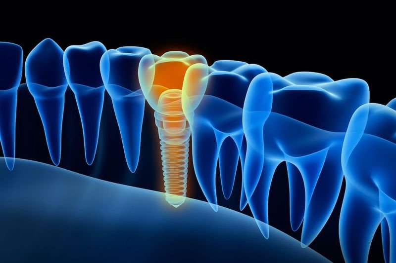 Dental Implant Failure