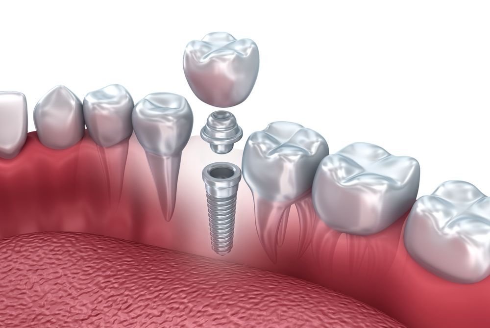 Dental Implant Failure
