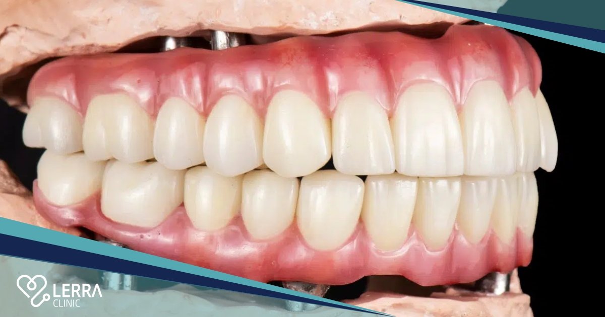 Dental Implant Failure