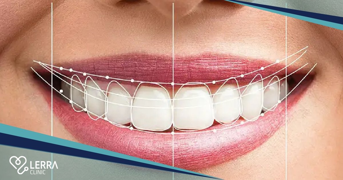 Full Mouth Rehabilitation in Turkiye