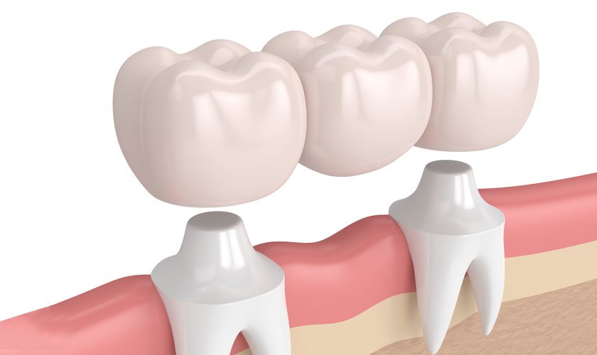 How Long Do Dental Crowns Last?