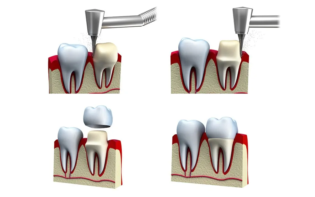 How Long Do Dental Crowns Last?