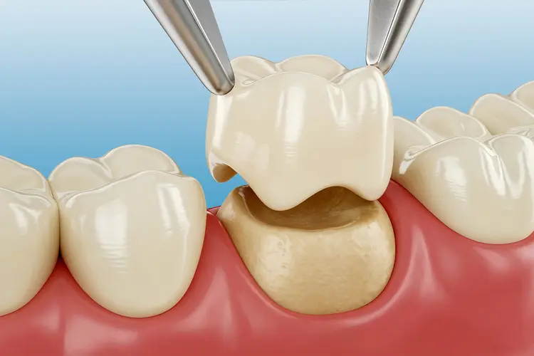 How Long Do Dental Crowns Last?