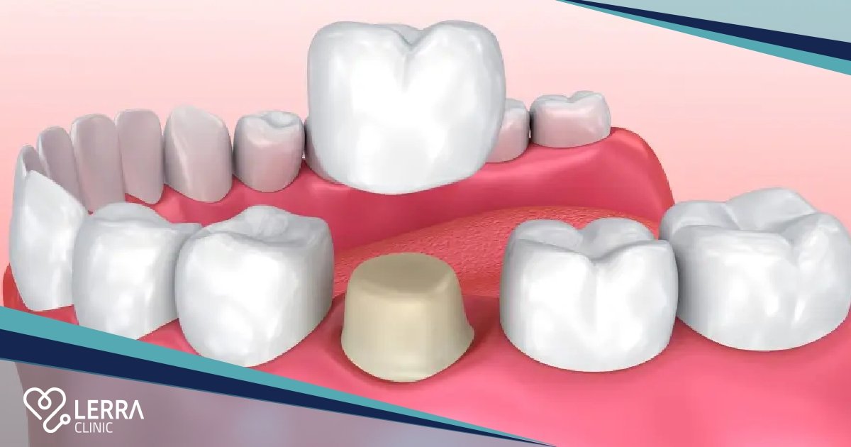 How Long Do Dental Crowns Last?