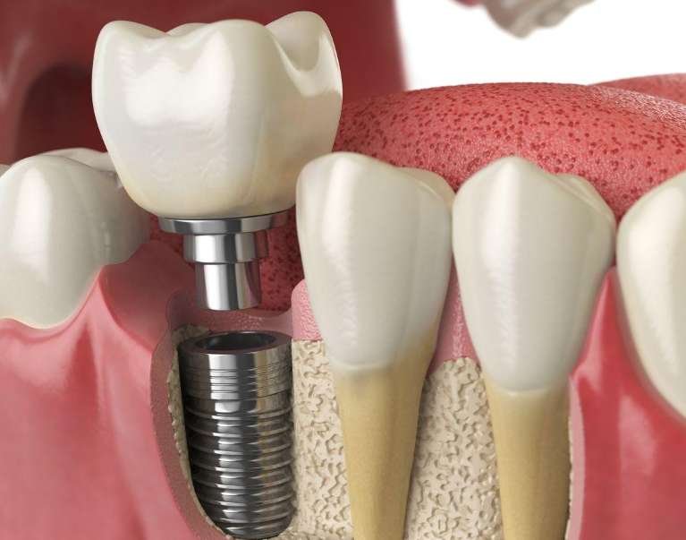 When Should You Avoid Implants?