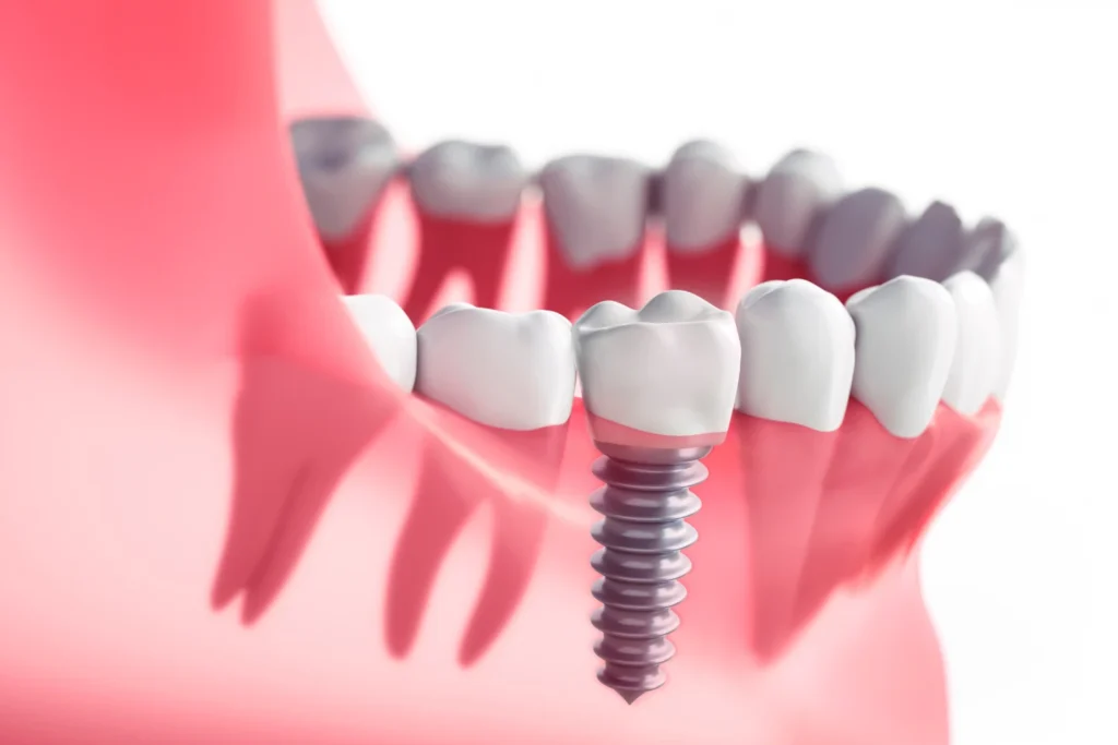 When Should You Avoid Implants?