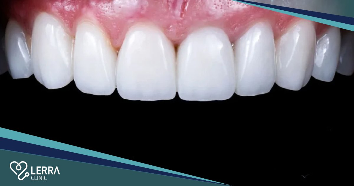 Emax Veneers Turkey