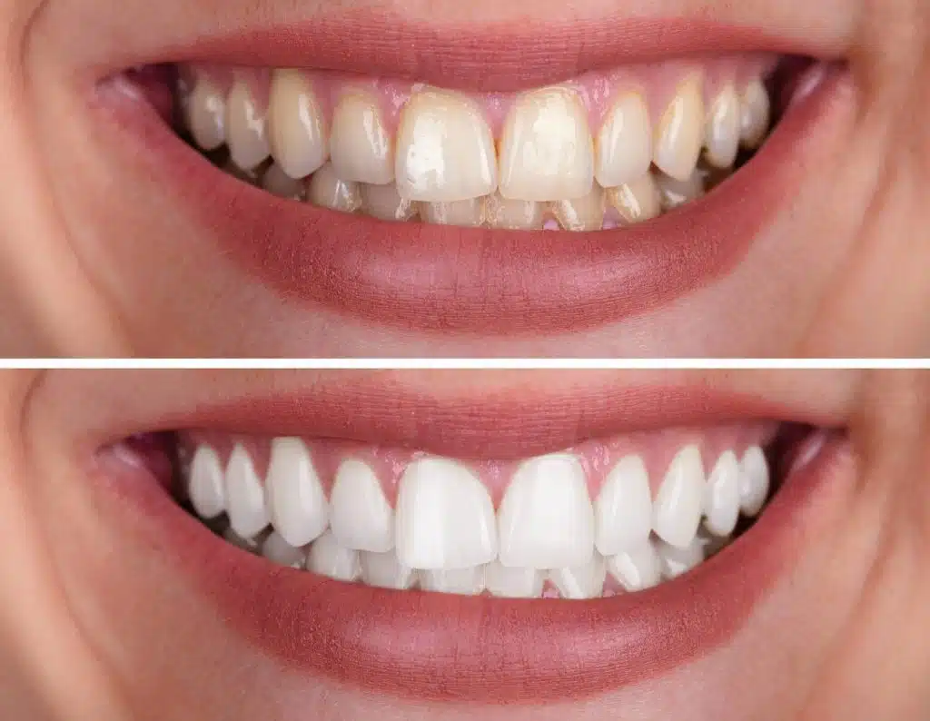 تجديد الابتسامة في تركيا
دليلك الشامل لتجديد ابتسامتك في تركيا 2026