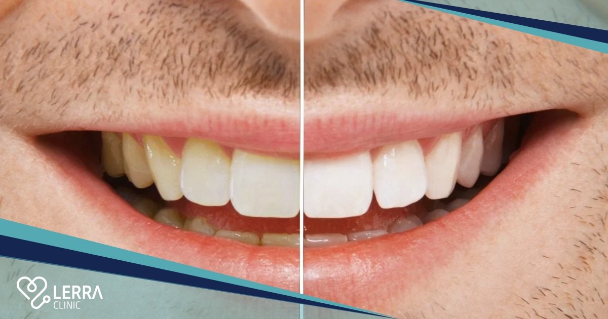 Smile Makeover Turkey