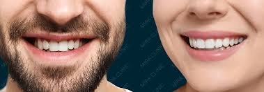 الفينير في تركيا