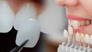 Facettes dentaires en Turquie