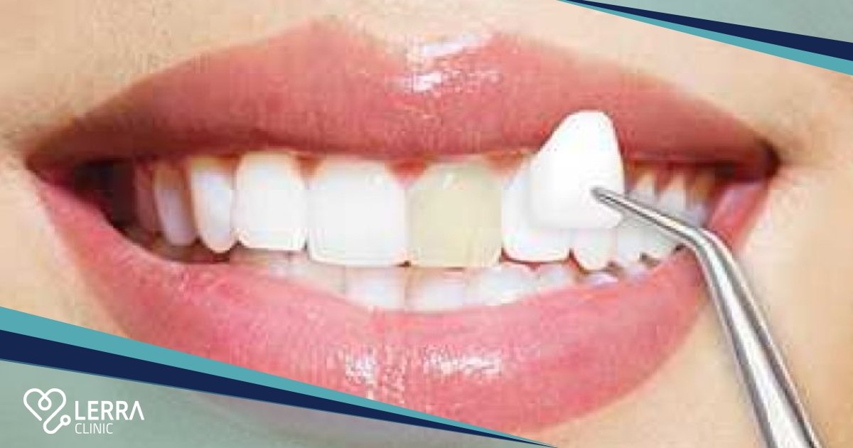 Veneers in Turkey