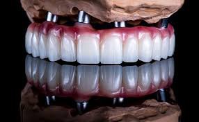 Dental implants in Turkey