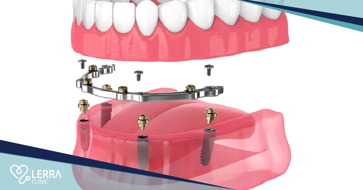 Dental implants in Turkey