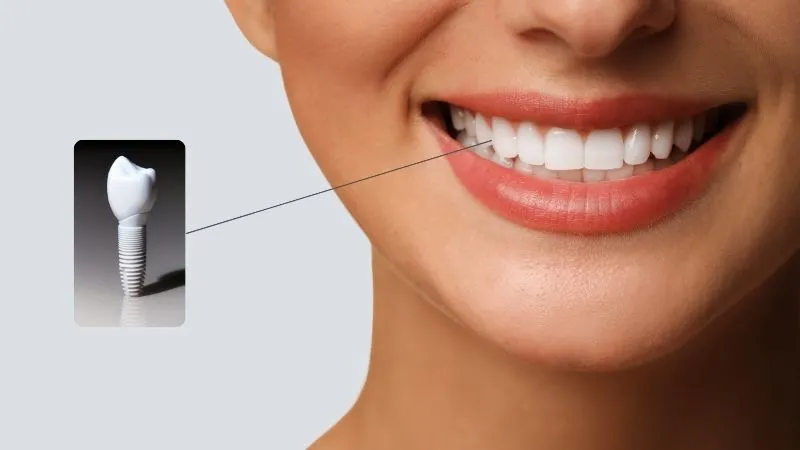 Dental implants in Turkey