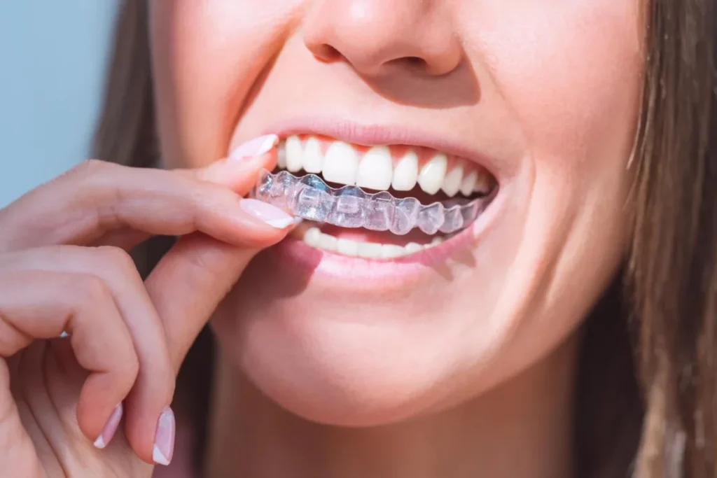 Invisalign Clear Aligners in Turkey