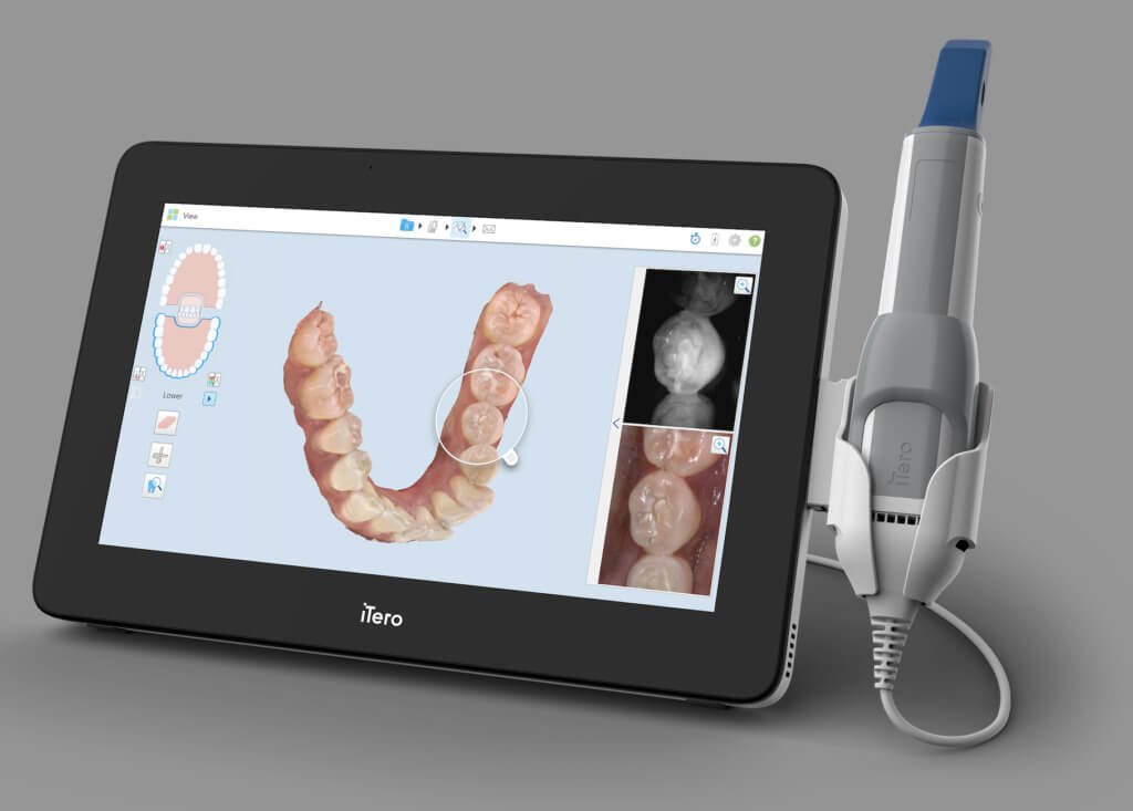 3D Intraoral Scanner