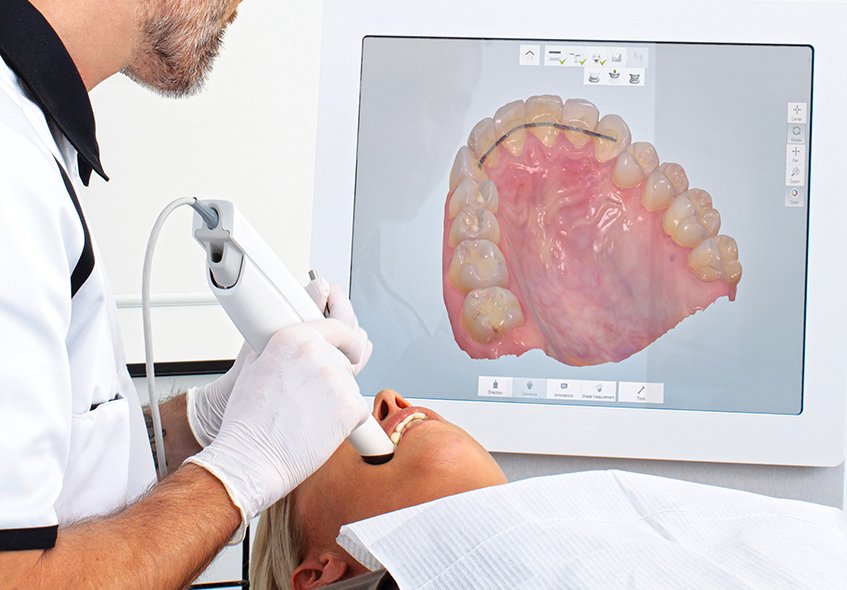 3D Intraoral Scanner