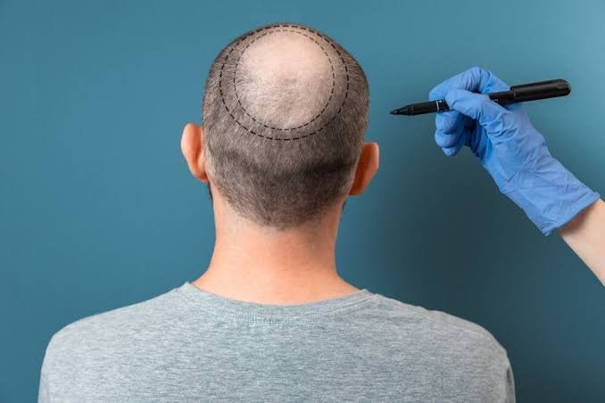 Hair Transplant for Men in Turkiye